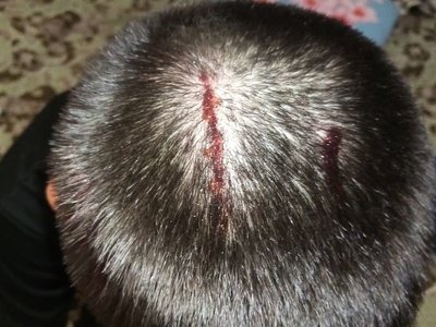 Подросток рассек голову на спортплощадке в Костанае