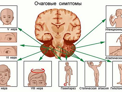 Опухоли головного мозга у детей – особенности и лечение|Видео