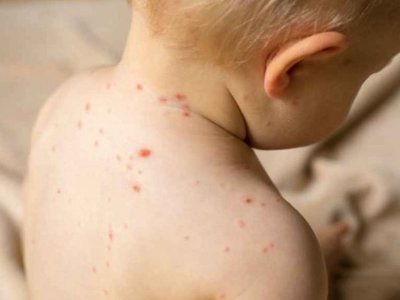 В соцсетях распространяют фейк о причине распространения кори в РК