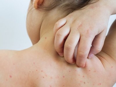 В Казахстане зафиксировано уже более 17 тыс. случаев кори – Минздрав