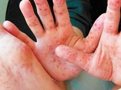 В Киеве фиксируют вспышку кори и гепатита А