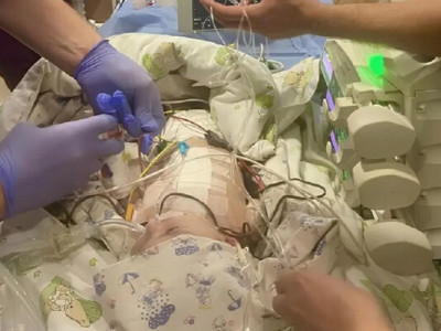 После уникальной операции: одесские врачи открыли новую страницу в детской кардиохирургии