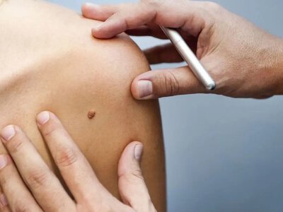 Рак кожи: базальноклеточная и плоскоклеточная карцинома