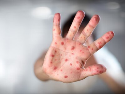 Школы и детсады Казахстана не будут принимать непривитых детей при регистрации случаев кори