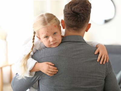 Ветрянка у ребенка: 5 фактов о ветряной оспе, которые должны знать все родители