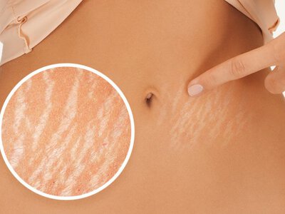 Как предотвратить появление растяжек: 5 способов сохранить кожу упругой