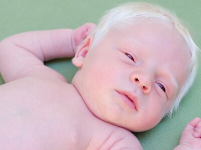 Генетические основы альбинизма: медицинские факты, дефицит меланина и сопутствующие проблемы со здоровьем