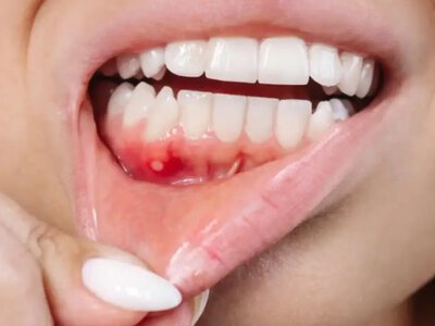 Новое открытие учёных — пятидневная диета может стать прорывом в лечении дёсен