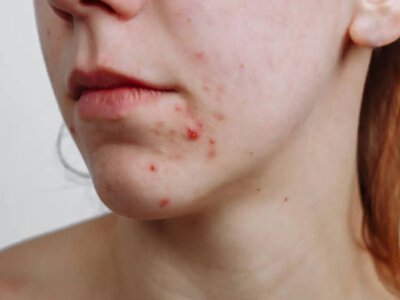 Почему высыпания вдоль челюсти могут быть первым звоночком гормонального сбоя