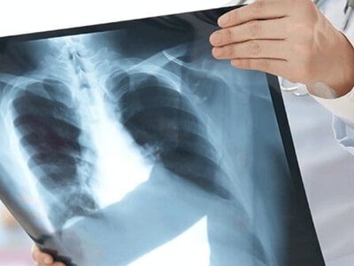 Лечение рака легких в Израиле: профессиональная медицинская помощь для каждого