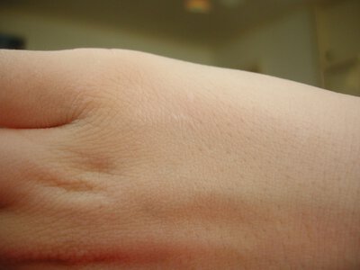 Приховані ознаки раку шкіри, які легко пропустити