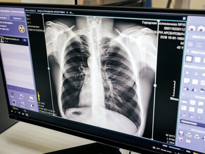  В Казахстане снова заговорили о скрининге рака легких 
