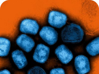 Чому mpox у 2022 році так швидко розійшовся світом: вчені з’ясували, що вірус став слабшим — і саме це могло допомогти