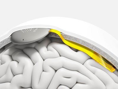  Американская Precision Neuroscience привлекла $250 млн на технологии связи мозга с компьютером 
