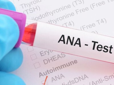 Когда и кому назначают анализ, интерпретация результатов: Тест ANA (антинуклеарные антитела)