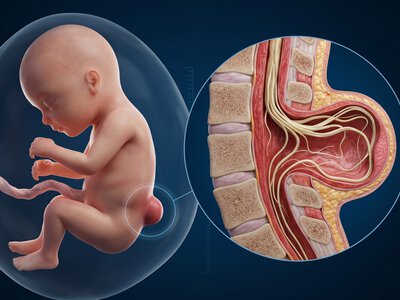 Причины возникновения Spina Bifida, роль профилактики при планировании беременности